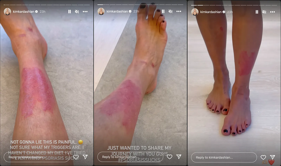 Kim Kardashian Opens Up About Painful Psoriasis Flare-Up and Treatment