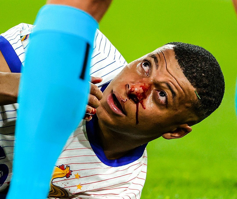 Kylian Mbappe Suffers Broken Nose in Euro 2024 Opener