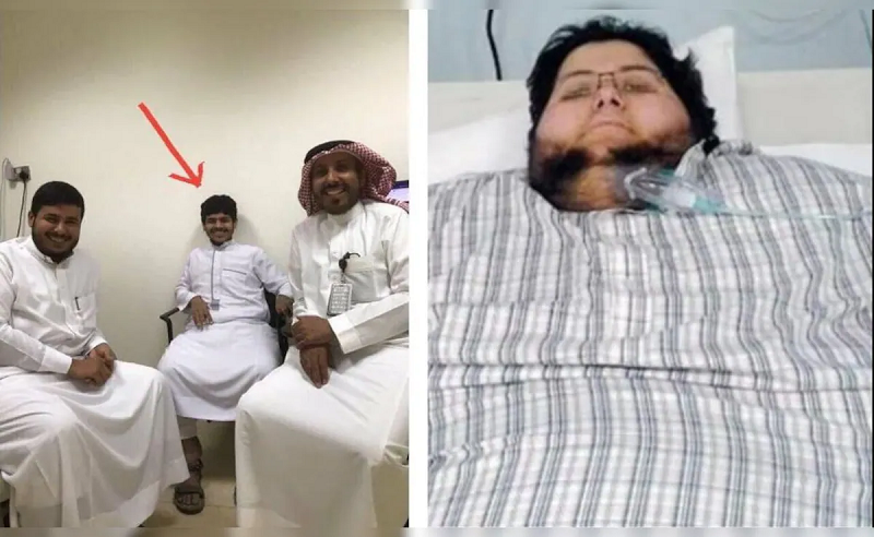 Former World’s Heaviest Man Achieves Unprecedented 542 kg Weight Loss with Royal Support